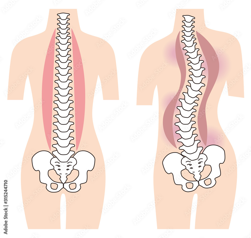まっすぐな背骨 歪んだ背骨 脊椎側弯症 Stock Illustration Adobe Stock まっすぐな背骨 歪んだ背骨 脊椎側弯症 Stock Illustration Adobe Stock