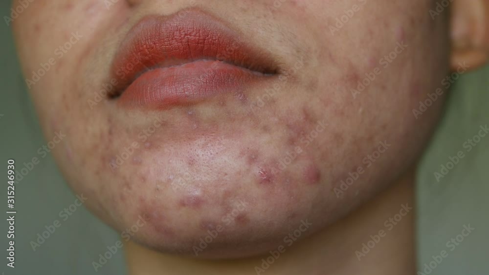 Close up skin problem and acne on Chin and face of women. Close up skin problem and acne on Chin and face of women.