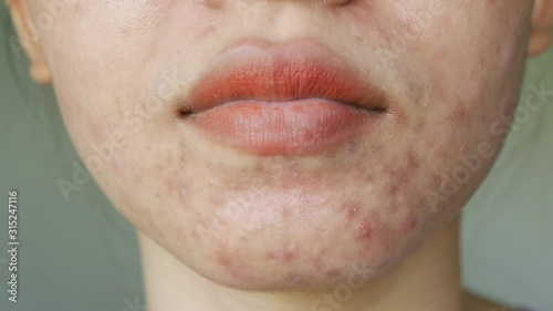 Women using equipment acne extractor pressing squeeze pimples on chin and face