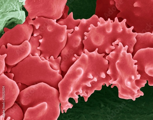 Crenated red blood cells, SEM photo