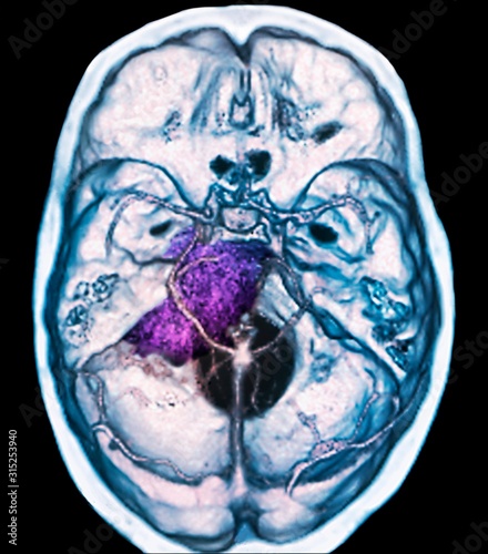 Benign brain tumour, CT scan