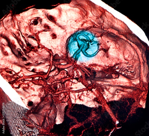 Brain haemorrhage, 3D angiogram photo