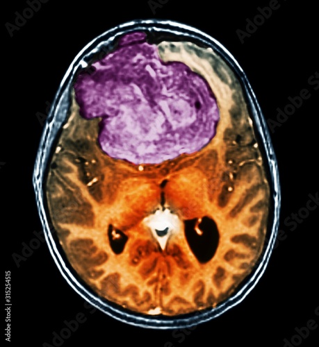 Benign brain tumour, CT scan photo