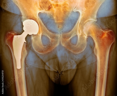 Total hip replacement, X-ray photo