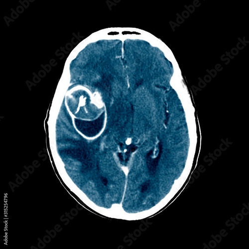 Aneurysm, CT scan