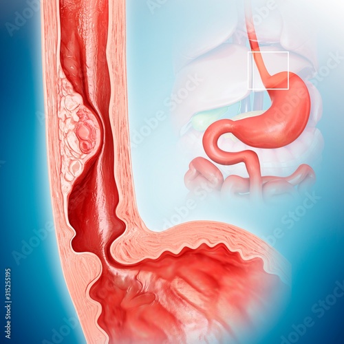 Oesophageal cancer, illustration photo