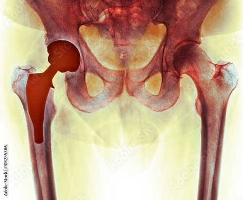 Total hip replacement, X-ray photo