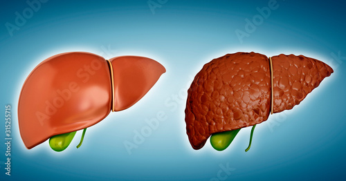 Liver cirrhosis, illustration photo