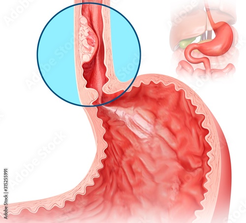 Oesophageal cancer, illustration