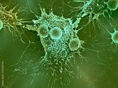 Cancer cell and T lymphocytes, SEM photo