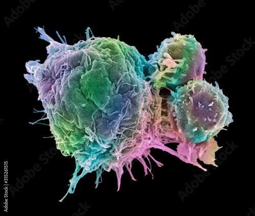 Cancer cell and T lymphocytes, SEM