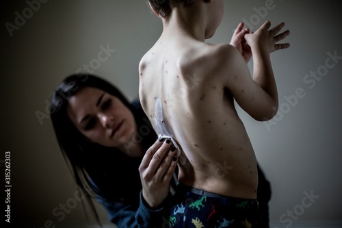 Boy with chickenpox photo