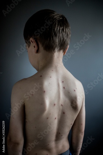 Boy with chickenpox
