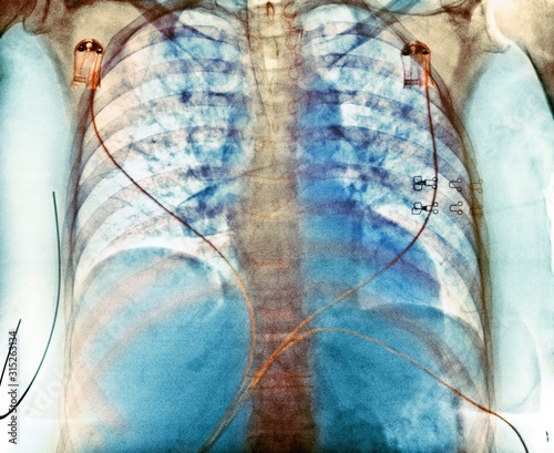 Aspiration, chest X-ray