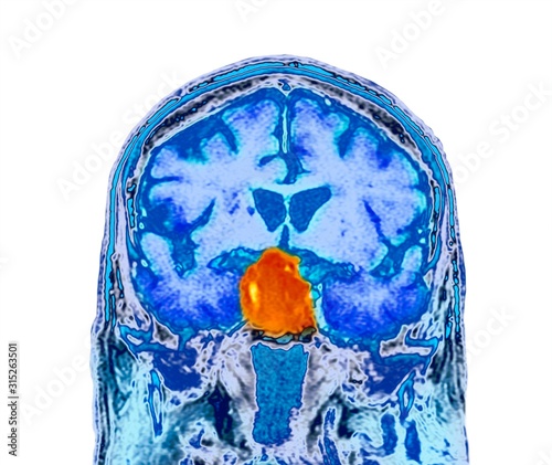 Pituitary tumour, CT scan photo