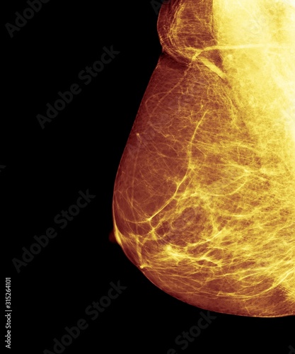 Breast cancer screening, X-ray