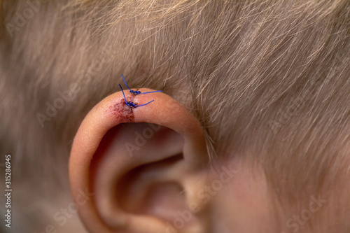 Wound stitches. Medical, surgical concept. Torn wounds with stitches on child ear.