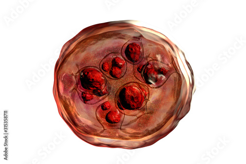Hydatid cyst of Echinococcus granulosus photo