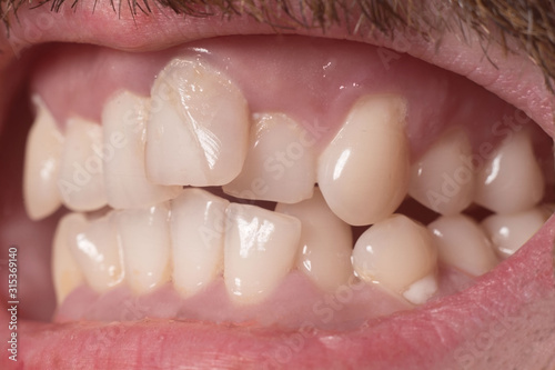 Close-up of very crooked teeth in an adult bearded guy. Not the right bite. Not healthy teeth. Violation of the position of the teeth in the jaws