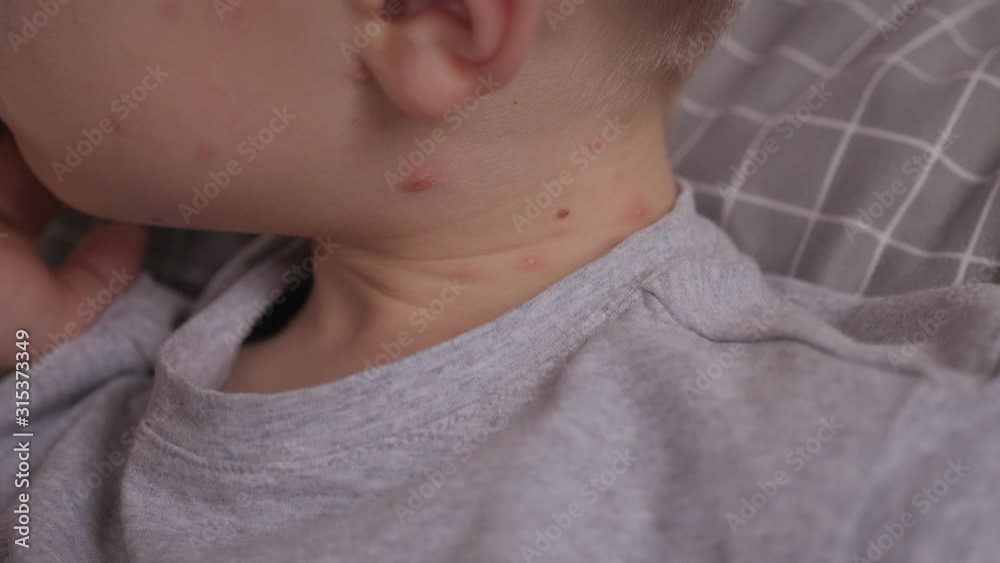 Close-up of a very large chicken pox blister on the neck of a small ...