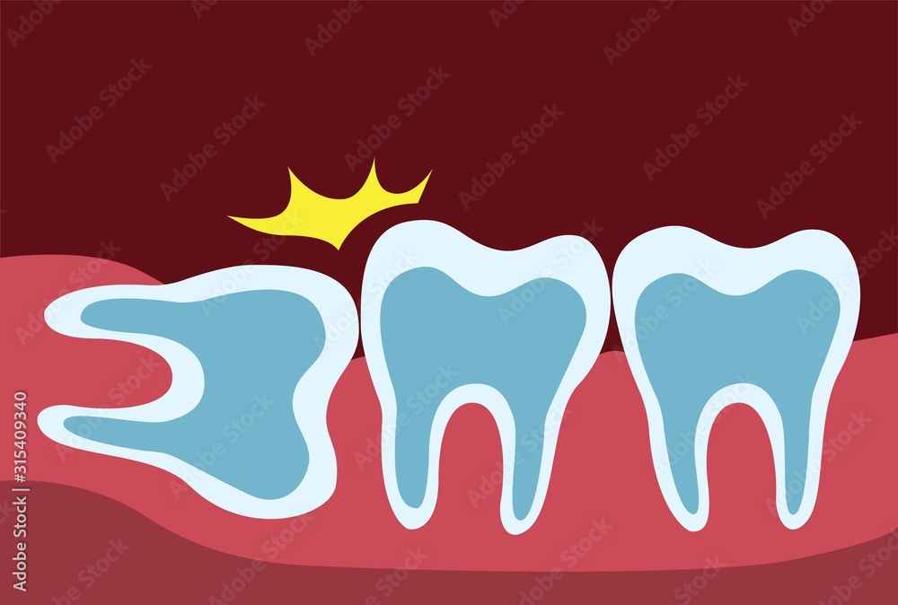 Wisdom tooth pushing adjacent teeth, wisdom tooth problem. teeth row and gum in x-ray cartoon flat illustration vector Stock Vector | Adobe Stock Wisdom tooth pushing adjacent teeth, wisdom tooth problem. teeth row and gum in x-ray cartoon flat illustration vector Stock Vector | Adobe Stock