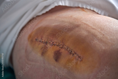 Clean large suture with staples bruises on thigh of anonymous patient after surgery in hospital