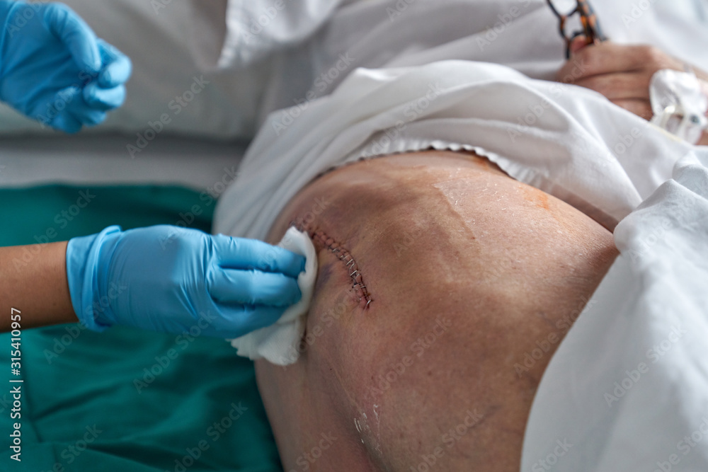 Crop nurse tending suture of elderly patient Crop nurse tending suture of elderly patient