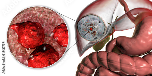Hydatid cyst of Echinococcus granulosus in the liver photo