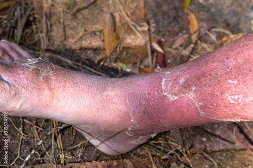 Cellulitis on leg and foot of mature diabetic man in daylight outdoors photo
