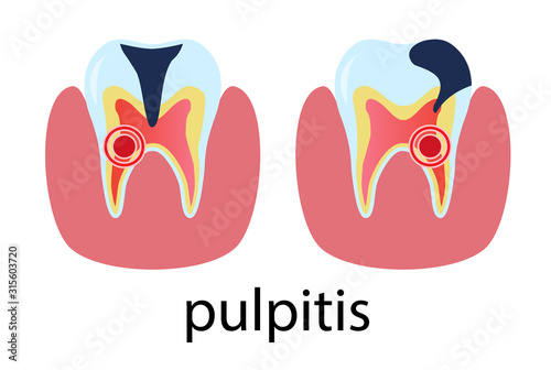 Dental treatment poster pulpitis. Human molar tooth in flat style. Vector illustration isolated on white.