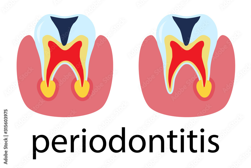 Dental treatment poster periodontitis. Human molar tooth in flat style. Vector illustration isolated on white. Dental treatment poster periodontitis. Human molar tooth in flat style. Vector illustration isolated on white.