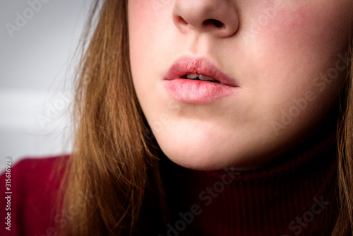 Fotografie Chapped, or cracked, dry lips that have lost moisture