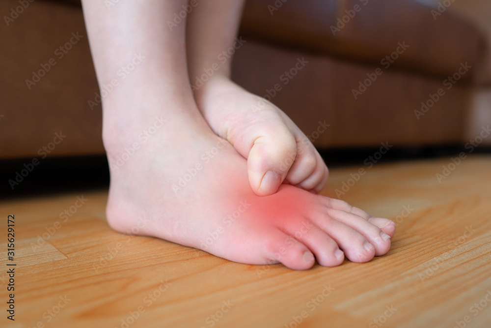 Young woman scratching the itch on her feet w/ redness rash. Cause of