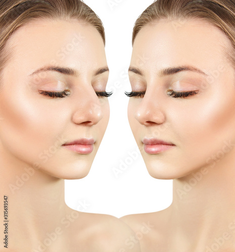 Female nose before and after plastic surgery.