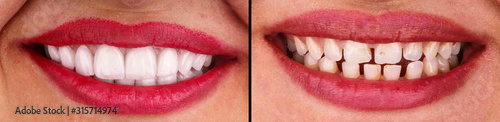 beautiful smile created by press ceramic veneers photo