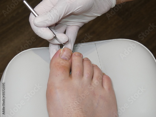 Podiatry, Chiropodist, medical foot care, podiatrist, ingrown toenail, fix an ingrown toenail photo