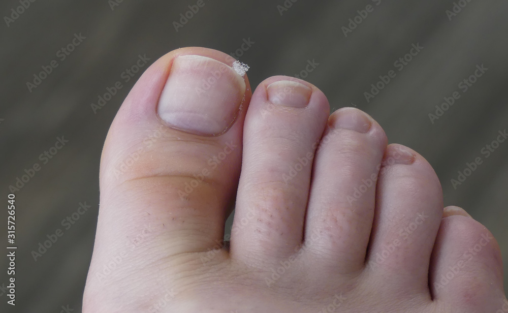 Podiatry, Chiropodist, medical foot care, podiatrist, ingrown toenail, fix an ingrown toenail Podiatry, Chiropodist, medical foot care, podiatrist, ingrown toenail, fix an ingrown toenail