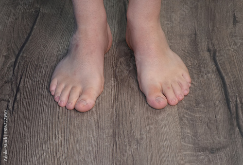 Chiropody Podiatry Medical Foot Care