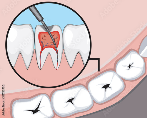 A pulpitis and molar or incisor with caries and pain in the gums, a vector stock illustration with a tooth as a treatment concept for a dental or orthodontic clinic