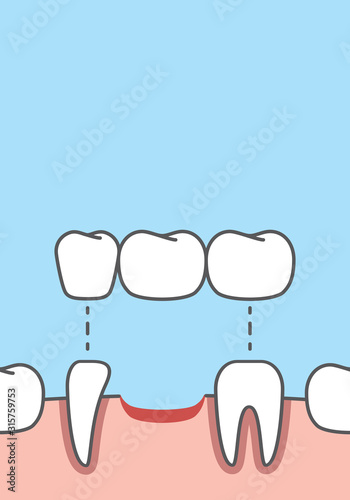 Blank banner Bridges teeth real root illustration vector on blue background. Dental concept.