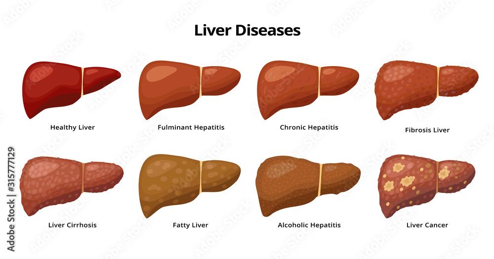 Healthy Liver and Liver diseases - fatty liver, hepatitis, fibrosis, cirrhosis, alcoholic hepatitis, liver cancer - medical infographic elements isolated on white background. - obrazy, fototapety, plakaty 