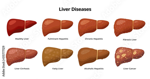 Healthy Liver and Liver diseases - fatty liver, hepatitis, fibrosis, cirrhosis, alcoholic hepatitis, liver cancer - medical infographic elements isolated on white background. photo