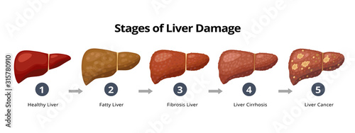 Stages of liver damage from healthy, fatty liver, fibrosis, cirrhosis to liver cancer. Medical infographic, liver diseases icons in flat design isolated on white background. photo