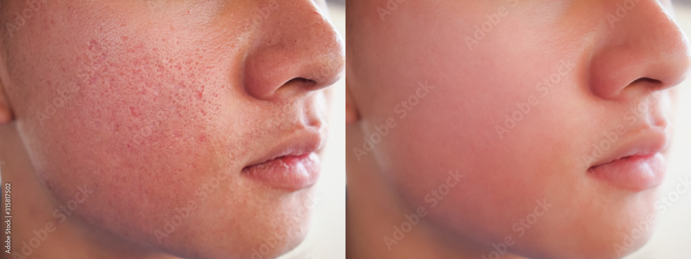 Image before and after spot red scar acne pimple treatment on face asian  man. Problem skincare and health concept. Stock Photo | Adobe Stock