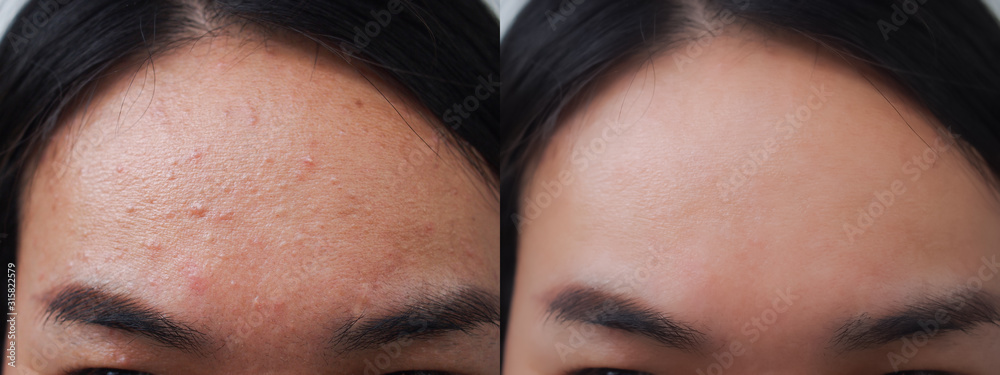 Obraz premium Image before and after acne pimple treatment on the face of young Asian woman.Problem skincare and beauty concept.
