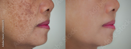 Fotografija Image before and after dark spot wrinkle melasma pigmentation skin facial treatment on face asian woman
