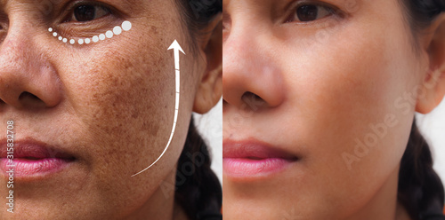 Image before and after anti-aging dark spot melasma pigmentation skin facial treatment rejuvenation of Asian woman .Problem skincare and beauty concept.