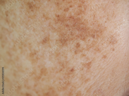 Problem skincare and health concept.Closeup wrinkles,melasma,Dark spots,freckles,dry skin,pigmentation on asian woman face texture background.