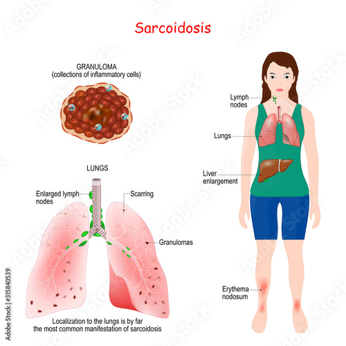 Sarcoidosis signs and symptoms. Development of granulomas