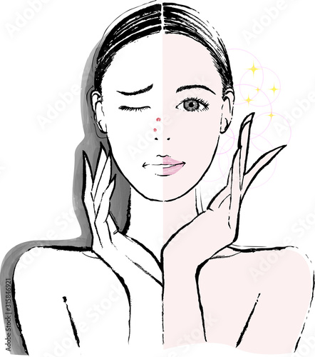 女性　鼻のニキビ　ビフォーアフター
